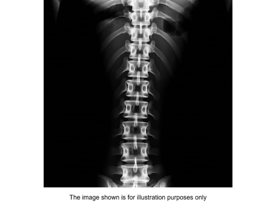 Spinal Hollow Tap